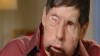 Second U.S. Face Transplant Patient Regains Feeling