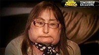 Face Transplant Patient to Donor Family: 'I Really Love Them for Being So Thoughtful'