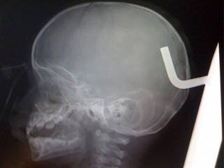 Photo: Boy with metal rod in brain