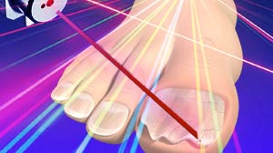 IMAGE: New laser treatment for toe fungus