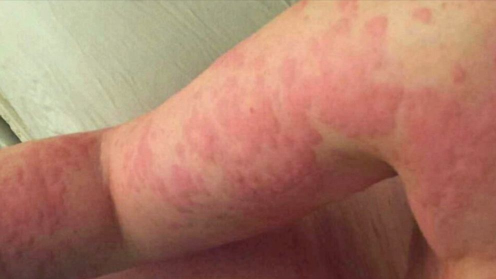 florida-woman-allergic-to-own-sweat-tears-details-her-ordeal-with-rare