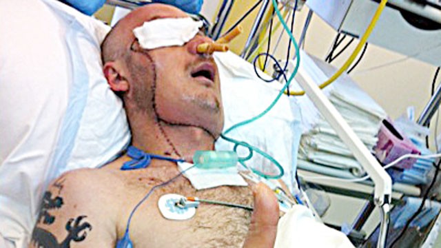 PHOTO: Polish doctors say they saved a mans life by performing a face transplant just three weeks after he was severely maimed in a workplace accident.