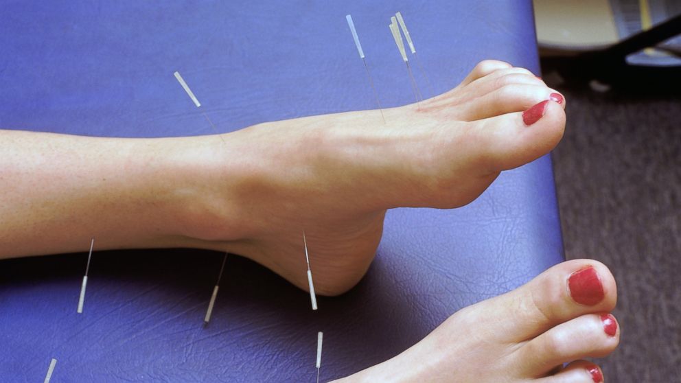 PHOTO: Some studies show that acupuncture is better for pain relief than pills or surgery.