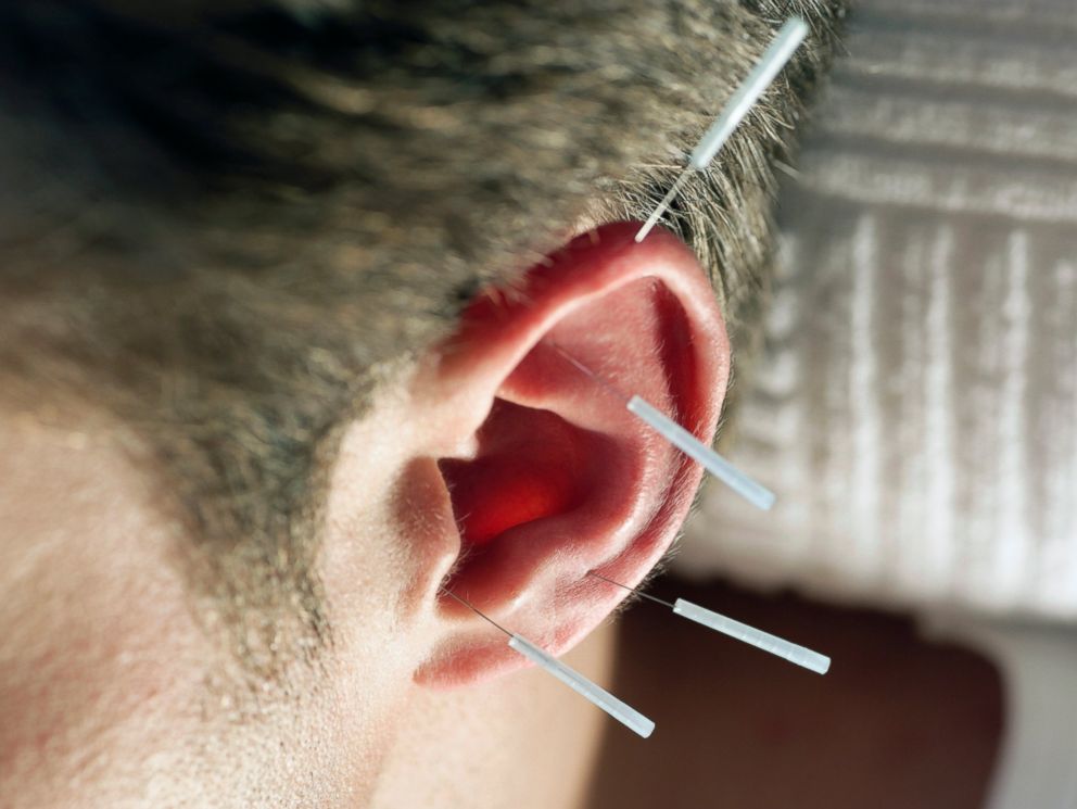 PHOTO: The military uses auricular acupuncture to treat pain on and off the battlefield.