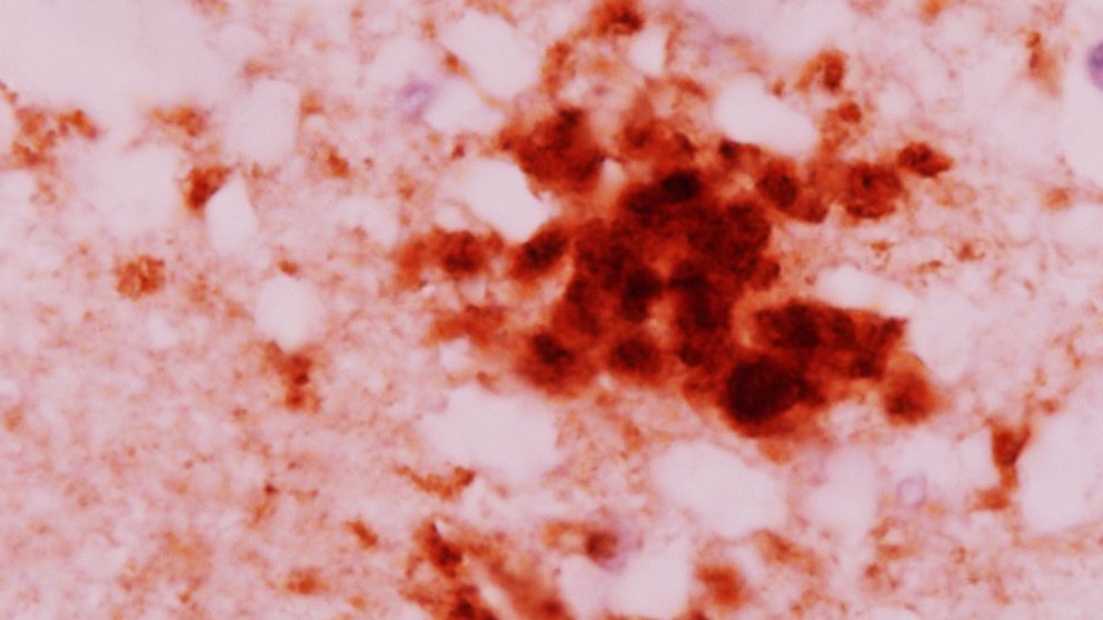chaperone proteins in mad cow disease chaperone proteins in mad cow disease