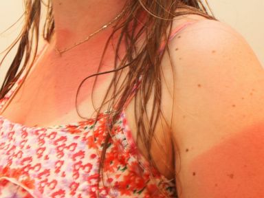 16 Summer Health Hazards and How to Beat Them