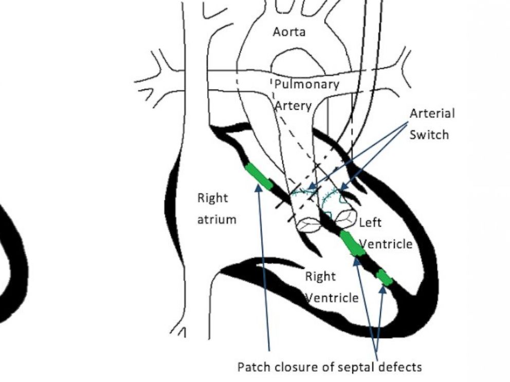 PHOTO: Graphic showing the surgical procedure that Four-month-old Fatemeh Reshad, who was born with a complex, life-threatening heart defect known as transposition of the great arteries, or TGA, will undergo to remedy his condition.