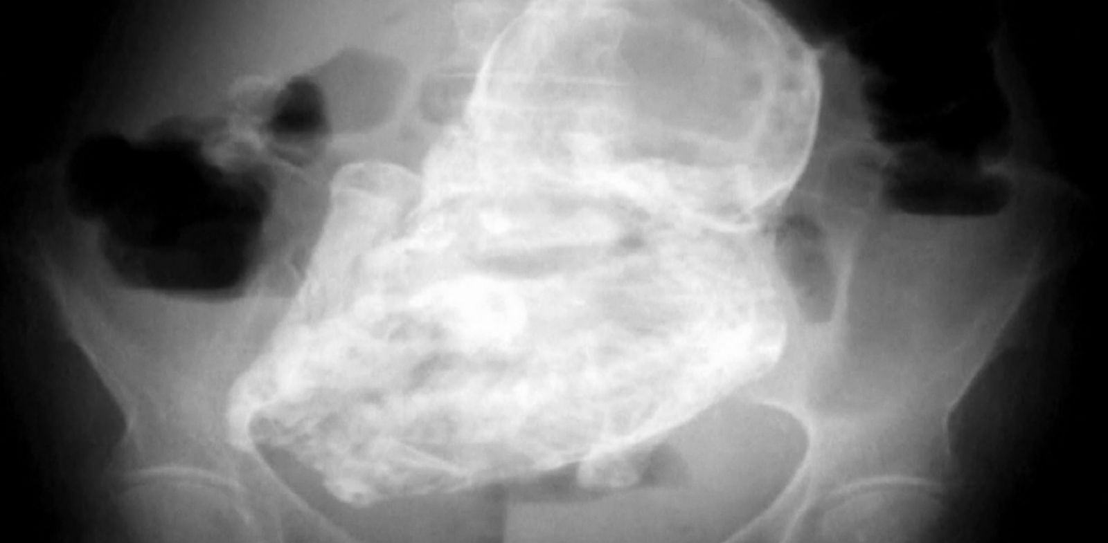 Rare 40YearOld �Stone Baby� Found in Elderly Woman ABC