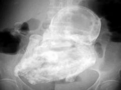 PHOTO: A 40-year-old calcified fetus has been discovered inside the abdomen of an elderly woman in Bogotá, Colombia.