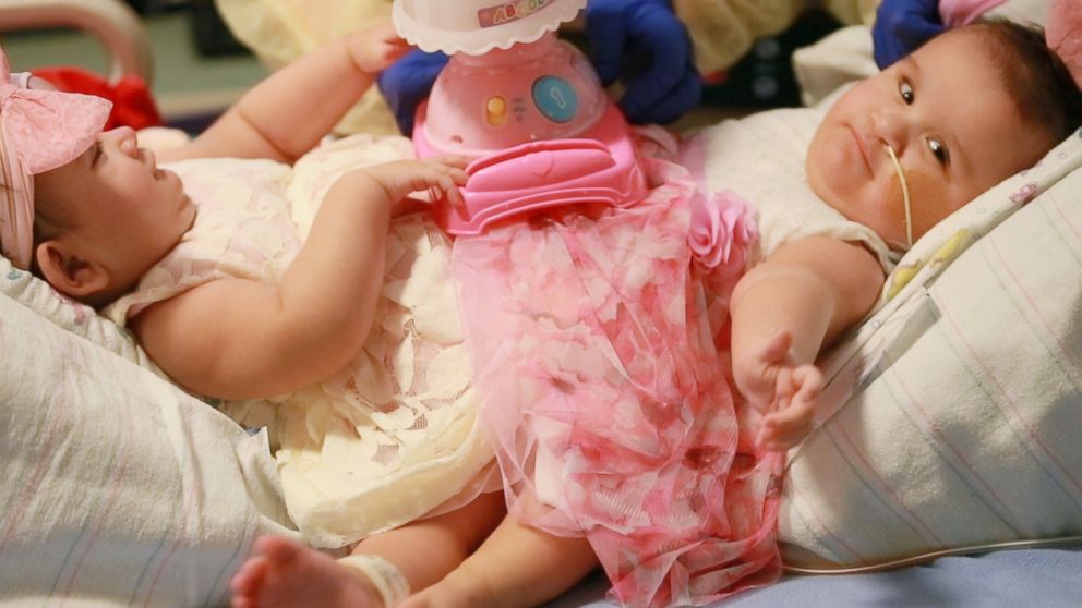 Conjoined Infant Twins, Connected At Waist Separated In Long Surgery ...