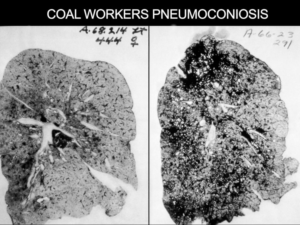 PHOTO: This occupational health image shows the lungs of a coal worker with Pneumoconiosis, or Black Lung Disease.