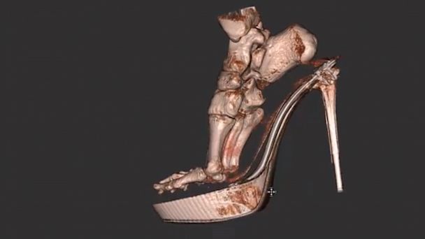 ... foot high heel nt 130826 16x9 608 3 D Scan Reveals Foot Damage by High