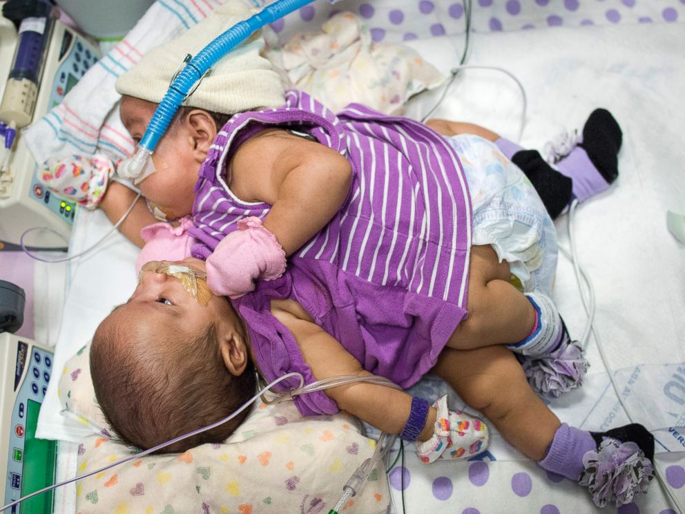 PHOTO: Elysse Mata gave birth to conjoined twins at Texas Childrens Hospital in Houston, April 11, 2014.