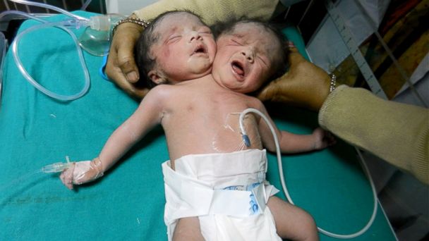 HT_conjoined_twins_jef_140313_16x9_608.jpg