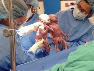 PHOTO: A pair of mono mono twins held hands after being born. 