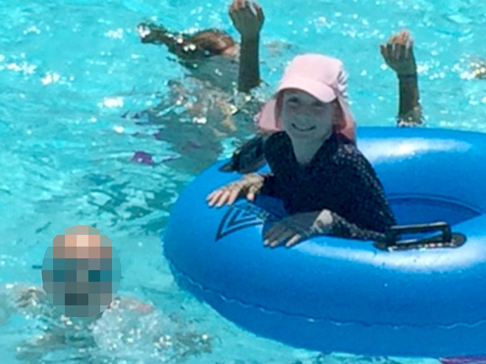 PHOTO: Savannah Fulkerson cannot spend time in the sun without causing injury to her skin.