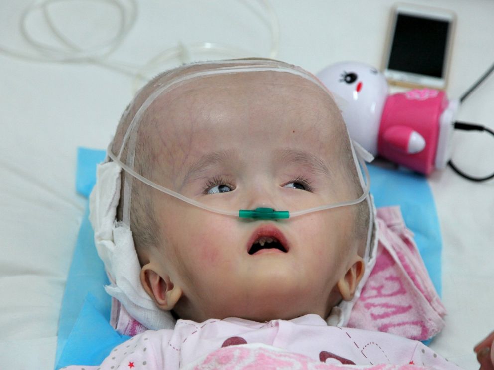 PHOTO: Three-year-old Hanhan is seen before a surgery to implant three pieces of titanium mesh to replace her skull, at a hospital in Changsha, Hunan province, China, July 14, 2015.