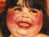 Mermaid Syndrome