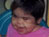 Mermaid Syndrome
