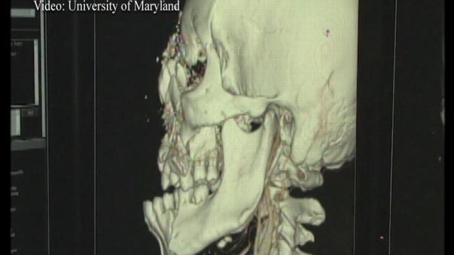 VIDEO: Surgeons at the University of Maryland succeed in the fullest face transplant ever.
