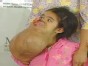 10-Pound Tumor