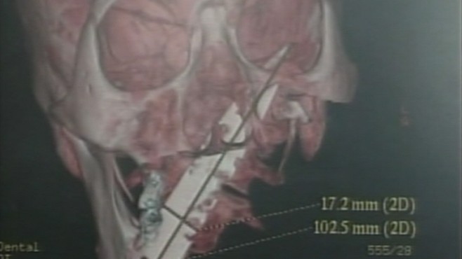 VIDEO: X-ray photographs reveal a 4-inch blade inside mans head, barely missing brain.
