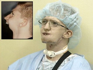Surgery Aids Teen With Half a Face