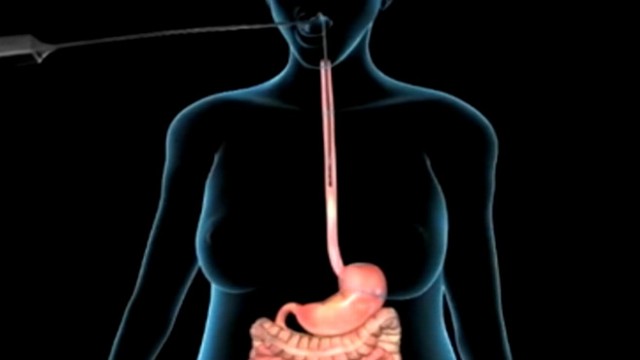 VIDEO: The AspireAssist stomach pump sucks food straight out of the user?s belly before the body can fully digest it.