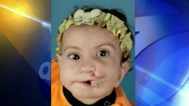 PHOTO: Rokaya Mohamed of Egypt was born with two full mouths. Last week, she underwent surgery at Childrens Hospital of Los Angeles to correct the condition.