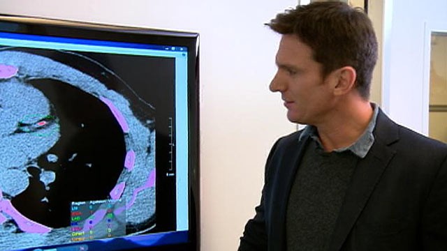 PHOTO: Dr. David Agus, one of the world's leading oncologists, shows "Nightline" anchor Bill Weir where he has a blocked artery in his heart.