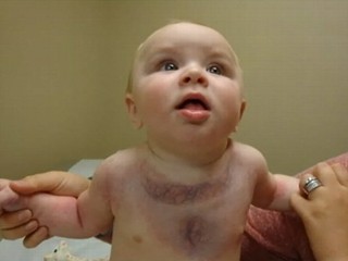 Baby's Disease So Rare, He Is 1 of 14 Cases