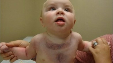 PHOTO: Seven month old Casen Buswell, has a genetic condition that hardens his blood vessels, skin and muscle.