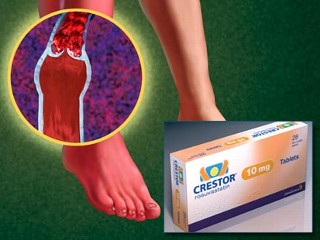Photo: Cholesterol drug Crestor also cuts risk of deadly blood clots, study says; wider use possible