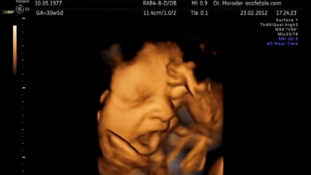 VIDEO: Study suggests yawns are due to "activity-dependent brain maturation."