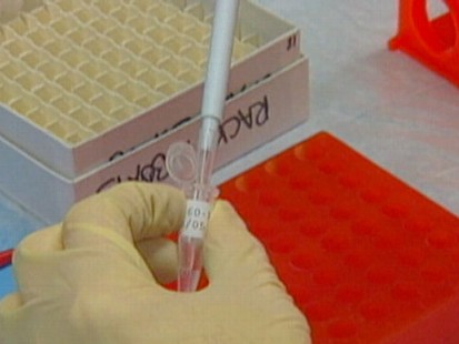VIDEO: A Look at Alzheimers Disease