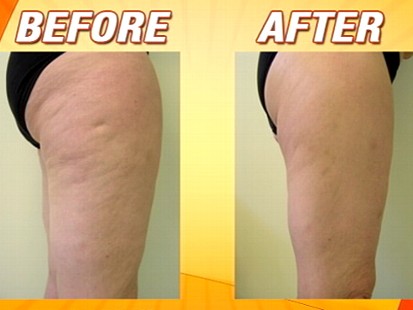 VIDEO: Procedures that can help you get them summer ready.