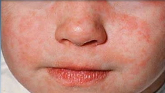 VIDEO: Measles Outbreak
