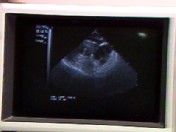 VIDEO: What to ask before a hysterectomy