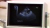 VIDEO: What to ask before a hysterectomy