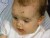 VIDEO: Study Says Chicken Pox Vaccine Reduces Risk For Shingles