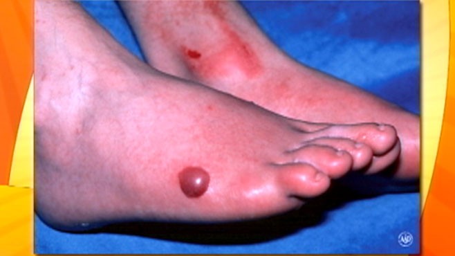 VIDEO: Find out why mixing certain fruits and the sun can be dangerous to your skin.