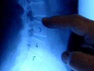 Back Pain