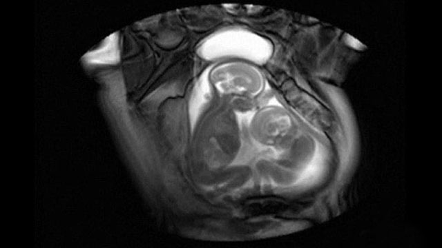 PHOTO: Using "cinematic MRI" scanner technology at Imperial College, London, researchers catch twin fetuses kicking one another.