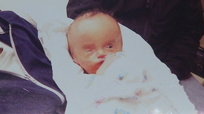 VIDEO: Parents of a 10-month-old boy raise awareness about his medical condition, hydrocephalus.