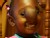 Video: Haitian girl will have large tumor removed from her face at the Mayo clinic.a