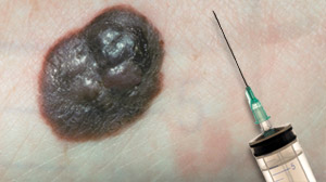 PHOTO In what researchers are calling a first, a vaccine that targets skin cancer cells shrinks tumors and cuts the chance that the disease will return.