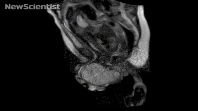 PHOTO: German researchers used MRI to peer inside a woman's body during labor.