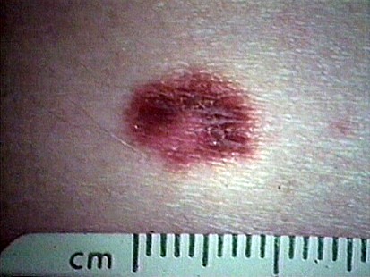 Melanoma