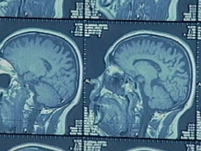 VIDEO: Electrical stimulation of the brain greatly reduces the frequency of seizures.