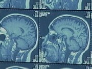 Promising Treatment for Epilepsy